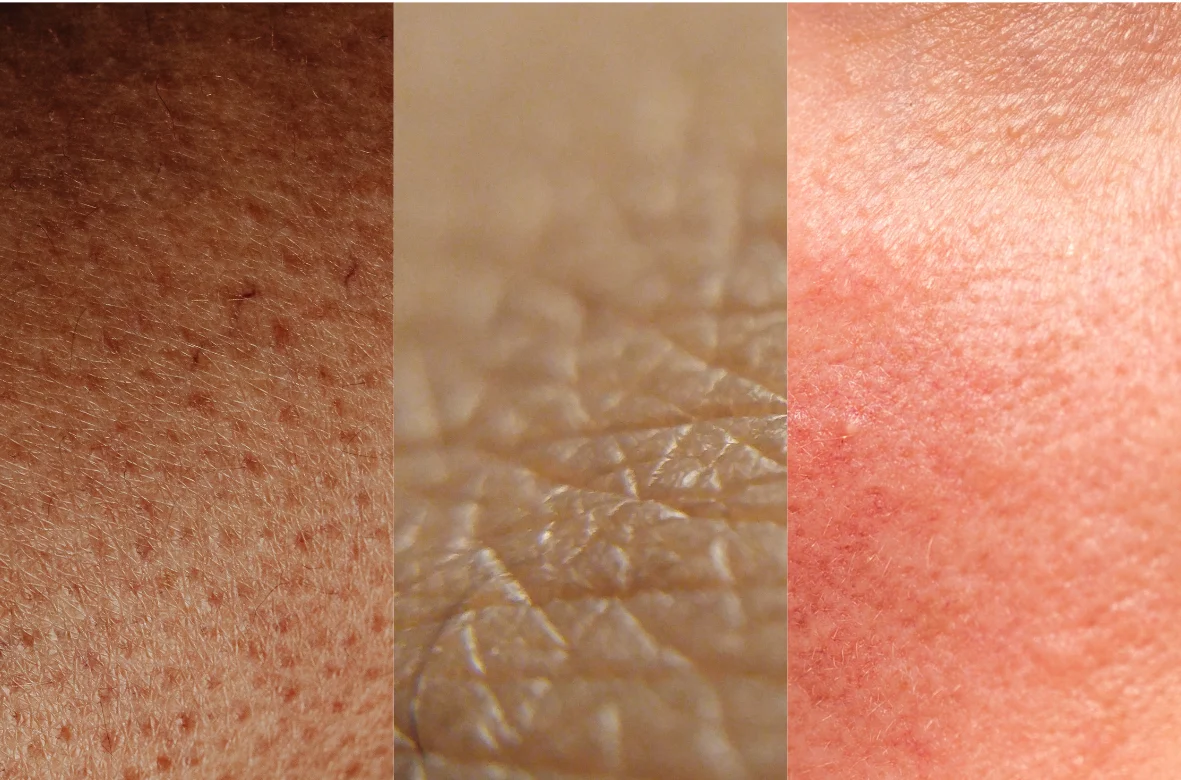 Una barriera cutanea danneggiata è un segnale d'allarme. 